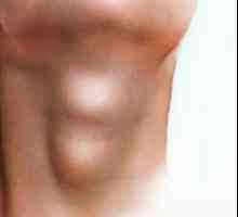 Totul despre nodurile din glanda tiroidă: simptome, diagnostic si tratament