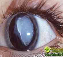 Toate metodele de populare și tratament clasic al cataractei