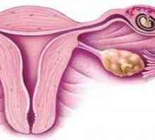Identificarea etapele timpurii ale sarcinii ectopice: simptome si diagnostic.