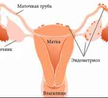 De ce este atribuit la terapie fizică pentru endometrioza