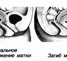 Bend (retroversiune) a gâtului uterului posteriorly