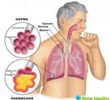 Pneumonie Congestivă ce este și cum să-l trateze