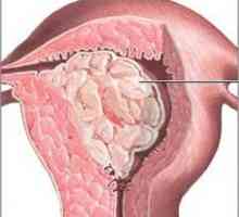 Glandulara hiperplazie endometriala: cauze, forme și etape de tratament