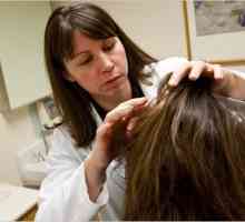 Uleios seboreea scalpului: tratamentul și prevenirea