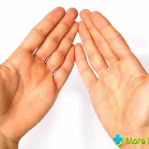 Dermatita atopica pe mâini: cauze, simptome, tratament si prevenire