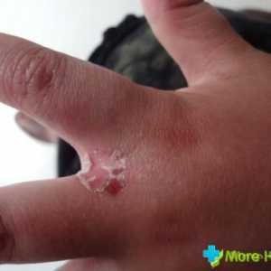 Alergică la pielea mâinilor: simptome și tratament