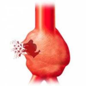 Anevrism al aortei abdominale: simptome, diagnostic, tratament