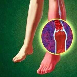 Angiopatie în diabetul zaharat: picioare si alte organe - semne, cum să trateze