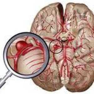 Principalele simptome de anevrism cerebral
