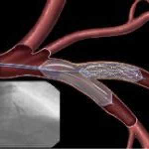 Angioplastia in tratamentul leziunilor vasculare