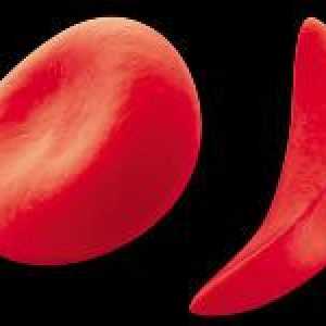 Anizocitoză globule rosii intr-un test de sânge (RDW index)