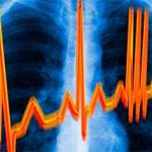 Aritmie cardiacă și tratamentul acesteia