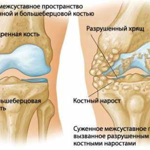 Artrita articulației genunchiului