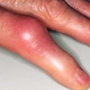 Artrita articulațiilor degetelor