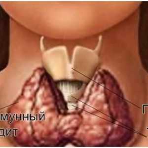 AT pentru a TPO (peroxidază tiroidă) a crescut foarte mult. Ce înseamnă?