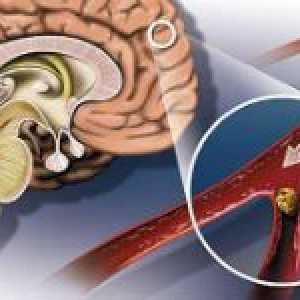 Ateroscleroza vaselor cerebrale și a simptomelor sale