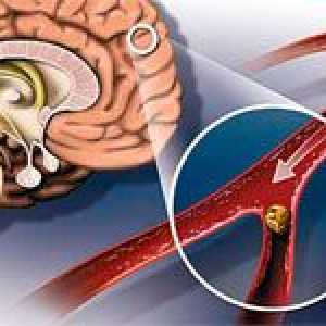 Ateroscleroza vaselor cerebrale ale creierului