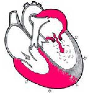Insuficiența valvei aortice și tratamentul acesteia