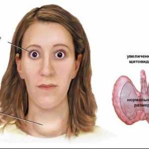 Endocrine Graves boala (boala Graves): cauze, simptome, tratament si prevenire