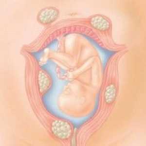 Sarcina și nașterea uterine miom