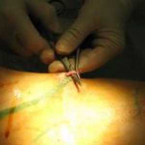 Tratamentul chirurgical al venelor varicoase la nivelul picioarelor