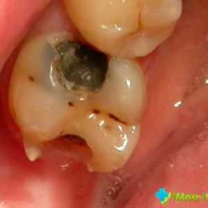 Durere de dinți pentru umplere temporară: Ai nevoie să sune alarma