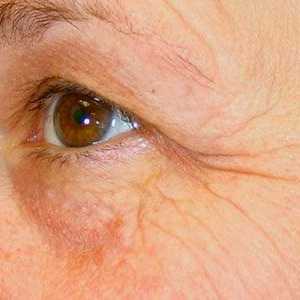 Botox-ul pe pielea din jurul ochilor - comentarii și descriere