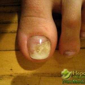 Ajutor rapid de la folk căile de atac ciuperca unghiilor