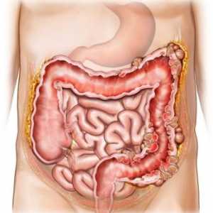 Cum putem trata intestinului Pneumatization?