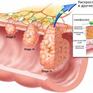 Patru etape de cancer la stomac