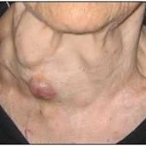 Care este hiperplazia tiroidă