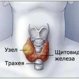 Ce este Gușa nodulară tiroidiană
