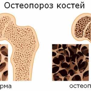 Ce fel de osteoporoza boli osoase