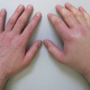 Ce ar trebui să fac în cazul în care umflarea mâinilor după somn