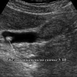 Ce vezica biliara cu ultrasunete?
