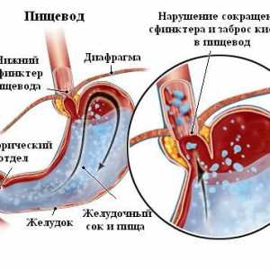 Ce este esofagita esofag?