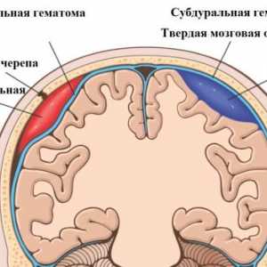 Simptomele și tratamentul hematom epidural al creierului