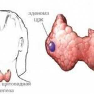 Ce este un adenom tiroidian, tipuri si tratamentul acesteia