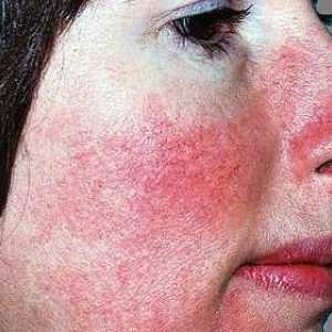 Ce este rozacee sau acnee rozacee: cauze, simptome, prevenirea