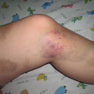 Ce este un prejudiciu picior, și mai ales tratamentul acesteia