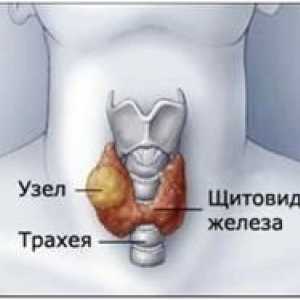 Ce este un nod în glanda tiroidă și dacă el este periculos