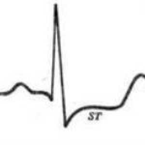 Semne ECG de angină cardiacă