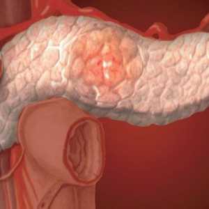 Care sunt cauzele modificările reactive ale pancreasului?