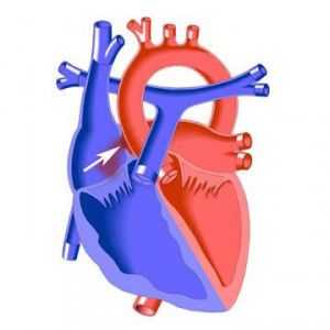Defect septal atrial a inimii la copii și adulți: cauze, simptome, cum de a trata