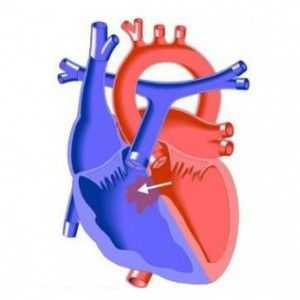 Inima defect de sept interventricular (VSD): cauze, simptome, tratament