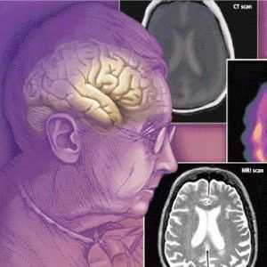 Demență (demență): simptome, tratament, cauzele senil, vasculare