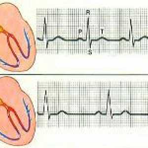 Diagnostic si simptome de tahicardie cardiacă