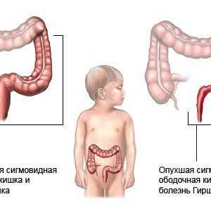 Diagnosticul și tratamentul dolihosigmoy copilului