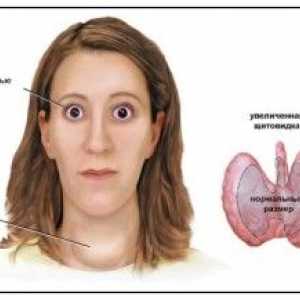 Boala Graves: cauze, simptome, diagnostic și tratament