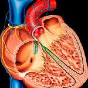 Cardiomiopatia dilatativă (DCM) și tratamentul acesteia
